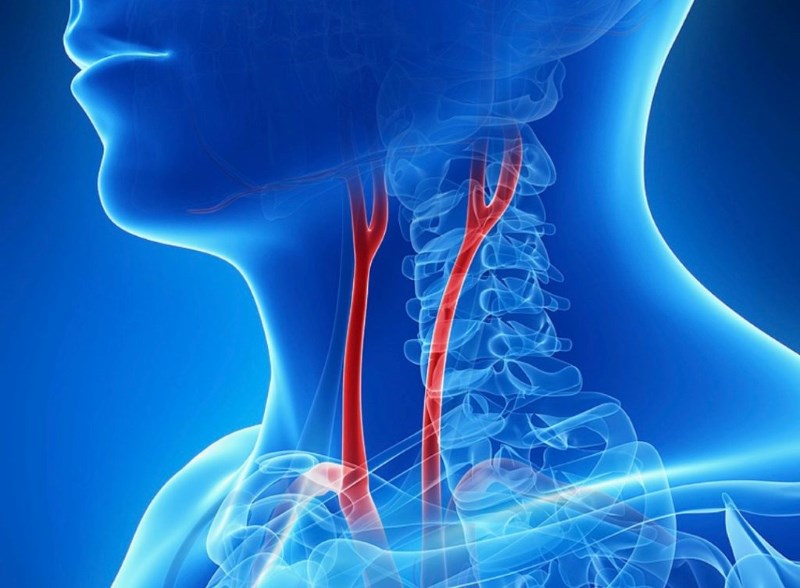 Cirurgia de Endarterectomia Carotídea